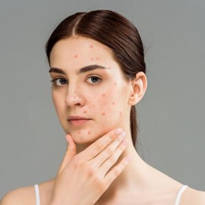 Laser acne treatment